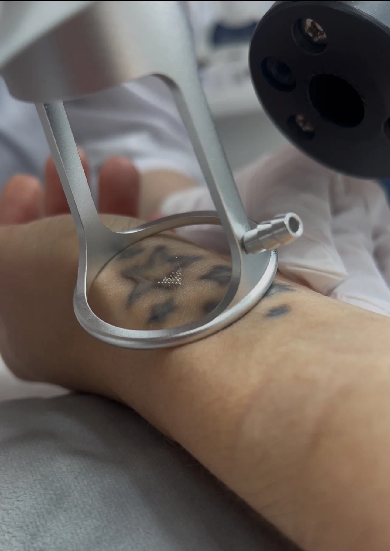 Лазерна CO₂ шліфовка шрамів і рубців