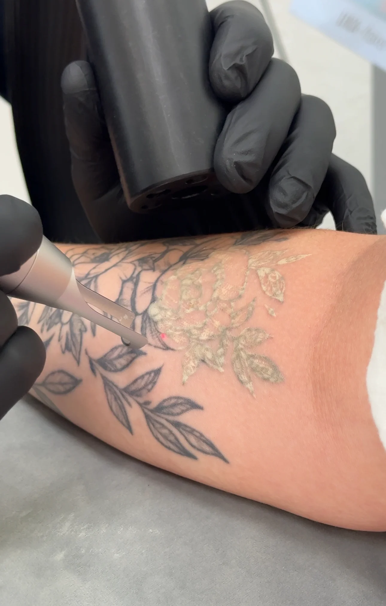 Лазерне видалення тату і татуажу